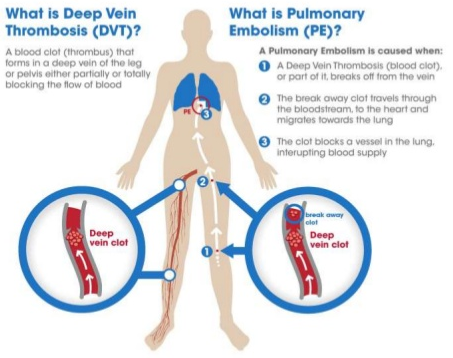 Venous thromboembolism